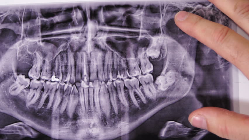 Close up shot of a dentist pointing out or indicating impacted wisdom teeth on the upper and lower jaw on a panoramic dental x-ray. Royalty-Free Stock Footage #16747099