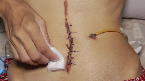 cleaning scar from operation  with a black fiber. Stitched up skin after an operation to remove a cancerous mole