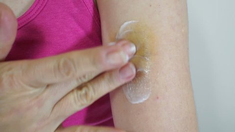 Close up shot of an anonymous woman putting a white cream on a large bruise on her arm so that the swelling goes down and it does not leave a scar.