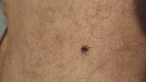 Insect parasite mite crawls on a man's leg. Tick on the skin.