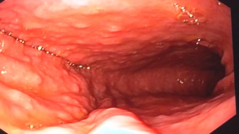 Gastroscopy examination of the gullet and stomach