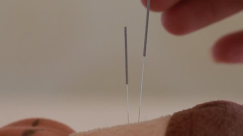 a group of acupuncture