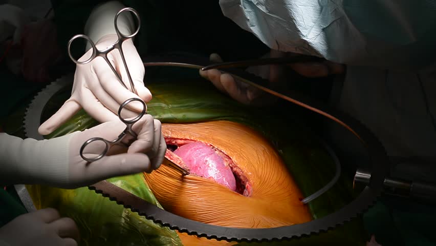 Kidney Transplant Operation Stock Footage Video 100 Royalty Free 17652700 Shutterstock