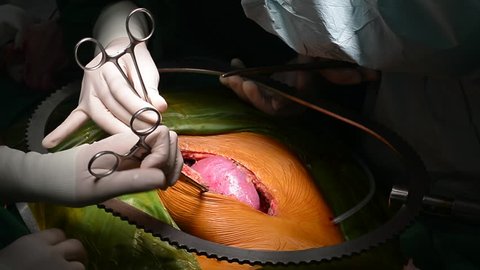 kidney transplant operation  
