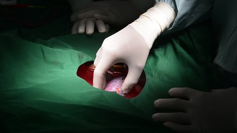 kidney transplant operation , Surgery Time Lapse