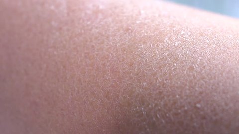 CLOSE UP, DOF, MACRO: Dehydrated, dry, flaky, cracked human skin on young Caucasian woman. Cold, wind and sun caused extreme dryness of outer layer of skin tissue on young woman leg
