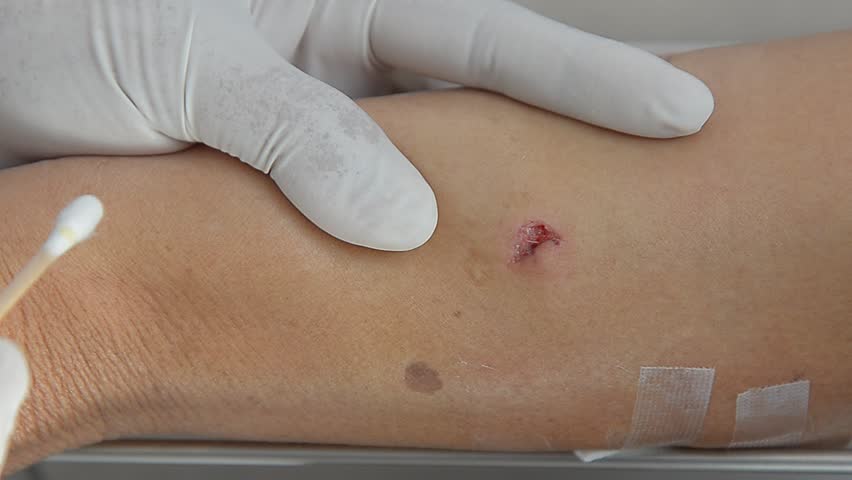 cleaning dog bite wound