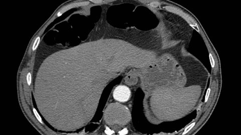 Computed Tomography Abdomen (CT SCAN)