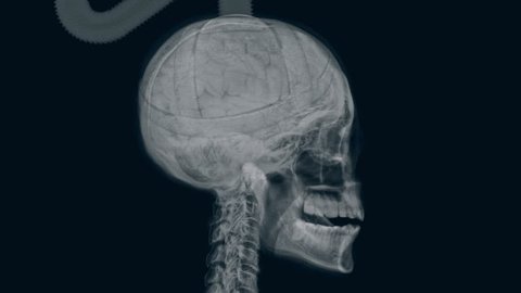 X-ray of electrocuted head.