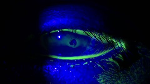 close up of penetrating injury with seidel test positive during eye examination. in dark room examination.