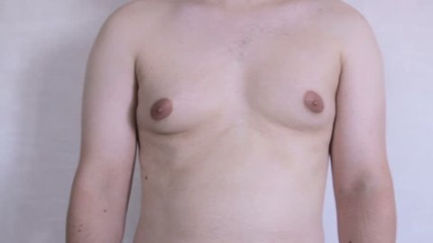 Male thorax showing  Gynecomastia or man boobs 