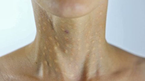 Woman Getting a Beauty Injection in her neck and decollete area. Young Woman in Cosmetic Clinic after Lifting Hyaluronic Biorevitalisation. Beauty Treatment - Papules after Hyaluronic Injection