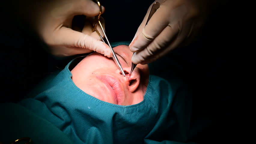 764 Rhinoplasty Stock Video Footage - 4K and HD Video Clips | Shutterstock 764 Rhinoplasty Stock Video Footage - 4K and HD Video Clips | Shutterstock