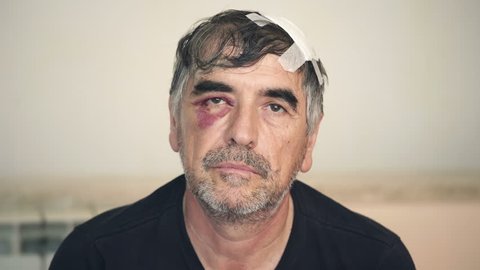 close up on alcoholic face ,after fight in a bar, staring at the camera