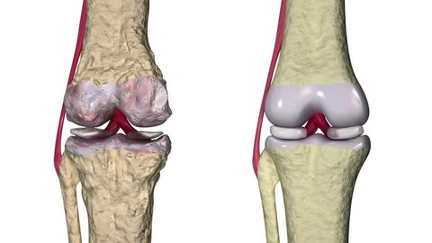 Osteoarthritis : Knee joint with ligaments and cartilages
