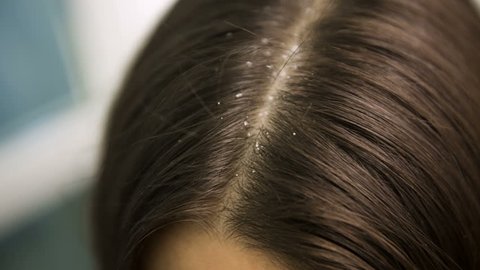 Dandruff disappear from woman's hair
