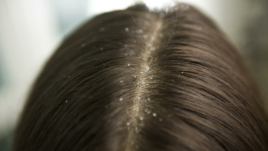 tea tree oil is can remove dandruff