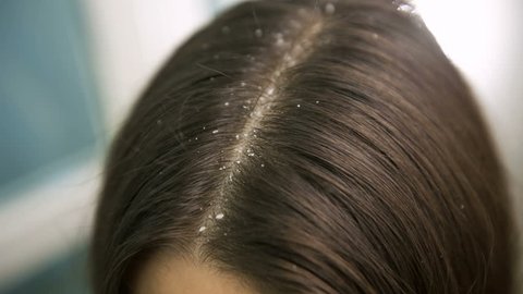 Dandruff on womans hair