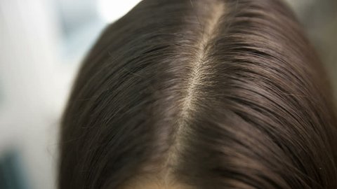 Problem hair with dandruff