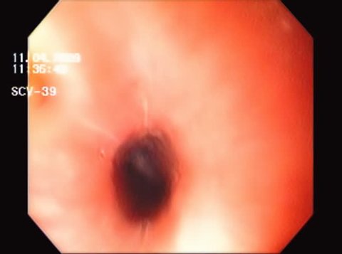 Esophagus Upward Motion Endoscopy. Esophagus channel seen from an endoscopic camera with upward motion with instrument leaving gut. Every ID info removed by special request for this video.