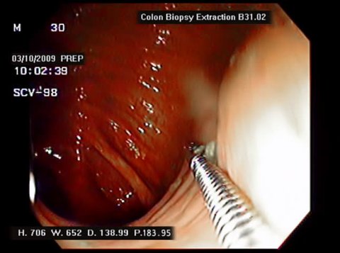 Colon Biopsy Tool. Endoscopic camera capture of intestinal wall biopsy of the colon. You can see the tissue extraction phase. All ID info has been painstakingly removed. 