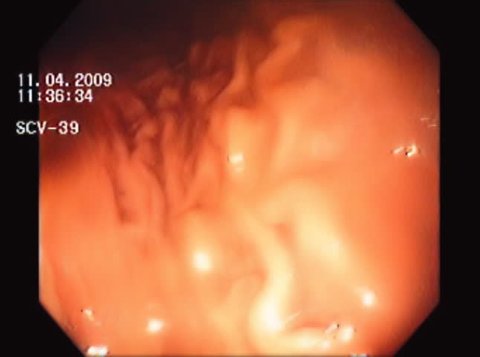 Stomach Gastric Wall . Stomach Wall being seen by endoscopic camera in search for ulcers. Every ID info removed by special request for this video.