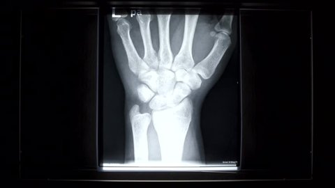 X-ray on illuminator panel - Hand