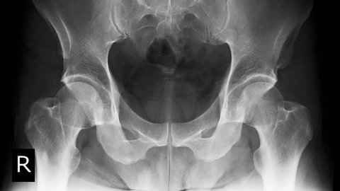 X-ray lumbo-sacral spine, pelvis, hip joint 