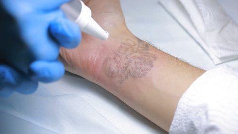 Laser tattoo removal with hand