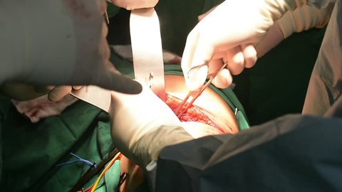 kidney transplant operation , Surgery
