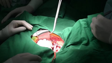 Kidney transplant operation , Surgery.