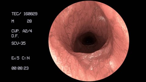 Endoscope medical camera gut intestine colon doctor endoscopy surgery 4k