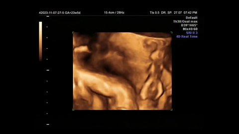 A 4d Ultrasound Of A Video De Stock 100 Libre De Droit Shutterstock