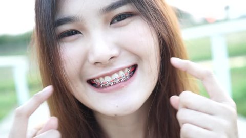 Slow motion : Young woman smiling with tooth brace