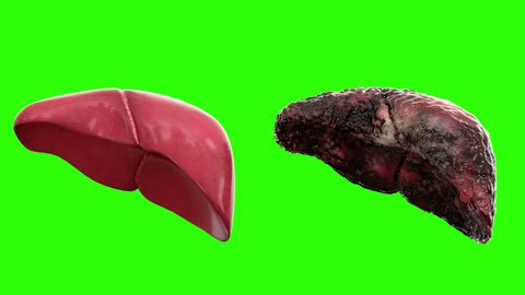 healthy liver and disease liver on green screen rotate. Autopsy medical concept. Cancer and smoking problem.