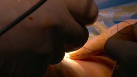 Calf implants. Doctor stitches