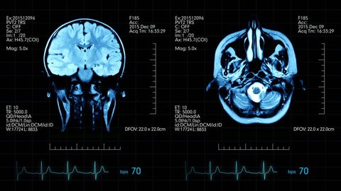 Two top view mri brain scan pictures animated on medical display with heart beat and additional medical data