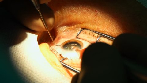 anesthesia before laser surgery vision correction, ophthalmology operation, Surgeon's hands in gloves performing laser eye vision correction correction, surgery eye, Cataract surgery 