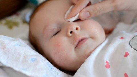 mother cleaning eyes and allergic rash on the cheeks of a newborn baby with physiological solution on a cotton strip