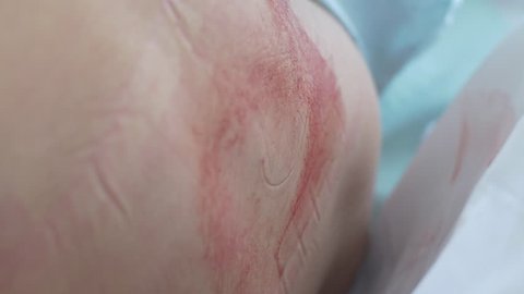 Nurse places bandage over epidural incision-extreme close up