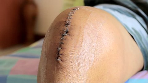 Close the incision wound with staples and wrap it in a clean dressing.Bone knee repair is a surgery to fix a broken bone using metal screws, pins, rods, or plates to hold the bone in place