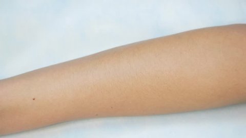 Fistula On Arm Result Operation Hemodialysis Stock Photo 1824465404
