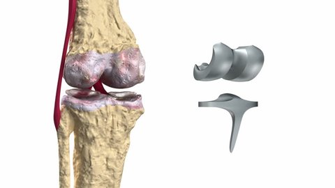 Knee and titanium hinge joint process
