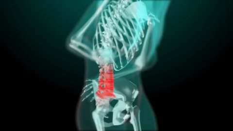 x-ray style - medical 3d animation of a female having acute pain in the back. Human anatomy