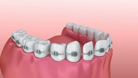 Teeth with braces alignment process. Medically accurate 3D animation.