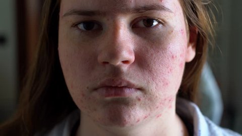Depressed girl with acne problem