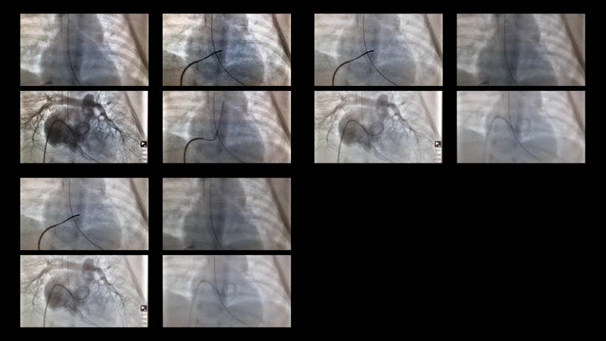 Monitoring of the catheter in the heart in the X-ray Royalty-Free Stock Footage #25483334