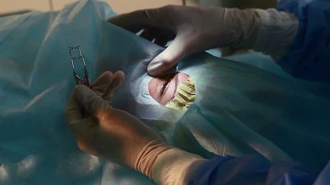 anesthesia before surgery laser vision correction, ophthalmology operation, Surgeon's hands in gloves performing laser eye vision correction correction, surgery eye, Cataract surgery