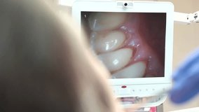 Intraoral camera monitor. Mouth inside view. Thorough teeth examination.