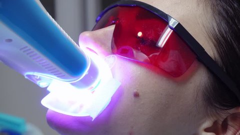 Young woman with an expander in mouth and red protective glasses getting UV whitening at the dentist's office by an ultra violet machine. Shot in 4k